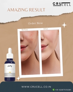 30ml alta calidad precio auténtico Crucell fiesta Peel para estiramiento de la piel Etiqueta Privada química Peeling para todo tipo de piel - Product Image 2