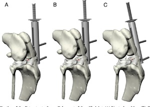 Leipzig stifle distractor cho arthroscopic đánh giá bên khum chó bụng phẫu thuật thiết bị bằng Pentax phẫu thuật - Product Image 3