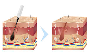 Electrodepilación profesional Epil Ultimate agujas Electrólisis Depilación Clínica de belleza Spa máquina Electro depilación - Product Image 5