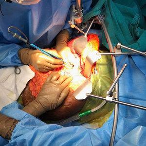 Offre Spéciale ALLEMAND Thompson Retractor Ensemble complet d'instruments chirurgicaux orthopédiques en acier inoxydable à vendre - Product Image 6