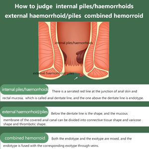 Crème naturelle à base de plantes pour les hémorroïdes : soulagement rapide des démangeaisons, de la douleur et de la brûlure, favorise le confort rafraîchissant, soutient une guérison douce. - Product Image 4