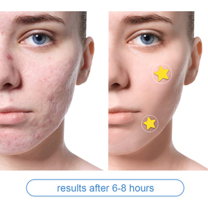 20PCS Yellow Star Hydrocolloid Acne <strong>Skin</strong> <strong>Tag</strong> <strong>Remover</strong> <strong>Patches</strong> Pimple <strong>Patch</strong> - Product Image 4