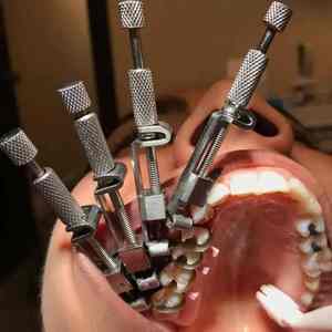 Tofflemire Matrix band คลิปหนีบตรงนำมาใช้ใหม่ได้ชุดเครื่องมือสแตนเลสแบบแมนนวลได้รับการรับรอง CE - Product Image 5