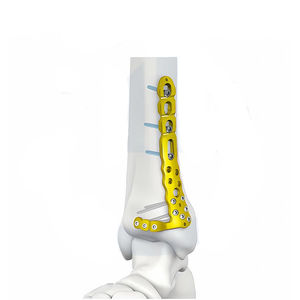 Plaque de fixation tibiale 3,5 mm, vis de fixation proximale distale médiale latérale, manuelle, en acier inoxydable et en titane - Product Image 2