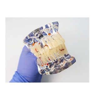 Modèle de pathologie dentaire avec demi-implant, modèle anatomique des dents pour l'enseignement dentaire, l'étude et la communication patient-dentiste - Product Image 5