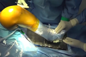 Instrumento ortopédico para artroplastia total de rodilla, posicionador de rodilla, distractor de pierna para cirugía de artroscopia, suministro sanitario - Product Image 6