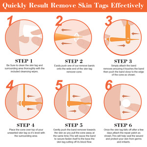 Bộ dụng cụ loại bỏ thẻ da điều trị dụng cụ làm sạch da Micro Band 2-8mm cho mụn cóc berrugas loại bỏ mụn cóc nốt ruồi chăm sóc mặt - Product Image 5