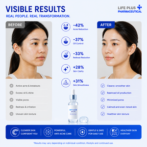 Sérum anti-acné pour le visage, traitement pour une peau claire, flacon, formule haute efficacité - Product Image 5