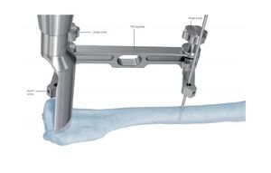 Implants TPLO 3.5mm Curved Plate Jig &lt;b&gt;Other&lt;/b&gt; &lt;b&gt;Veterinary&lt;/b&gt; &lt;b&gt;Instrument&lt;/b&gt; Rapid &lt;b&gt;Instrument&lt;/b&gt; Set Joint Implant for &lt;b&gt;Veterinary&lt;/b&gt; - Product Image 3