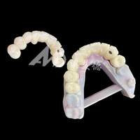 Jembatan Gigi PFM (Porcelain Fused to Metal) dan Mahkota yang Andal untuk Restorasi Gigi yang Fungsional dan Estetis