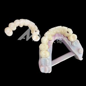 Pont <span class=keywords><strong>dentaire</strong></span> en porcelaine fusionnée au métal (PFM) fiable, couronne pour une restauration <span class=keywords><strong>dentaire</strong></span> fonctionnelle et esthétique - Product Image 2