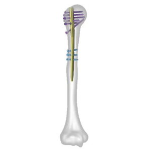 Clou intramédullaire huméral en acier inoxydable, instrument chirurgical orthopédique manuel de haute qualité, certifié CE, réutilisable - Product Image 4