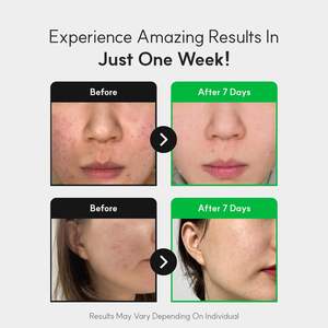 ครีมบำรุงผิวหน้าสูตรเซนเทลล่า กลีเซอรีน นิวแอลทูวีเอส 50 มล. ช่วยฟื้นฟูเกราะป้องกันผิว ลดรอยสิว บำรุงผิวขาวใส ให้ความชุ่มชื้นทุกวัน - Product Image 3