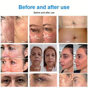 Appareil de beauté anti-âge et de remodelage du visage et du corps 2026 à haute intensité avec doubles poignées, couches SMAS de 2,0 mm à 18 mm pour le nettoyage du visage - Product Image 6