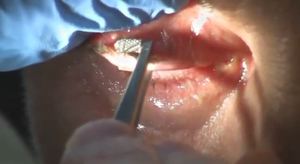 Rodillos de Acero Inoxidable para Eliminar las Glándulas de Meibomio, Pinzas de Extracción Manual para Cirugía Oftálmica, CE ISO - Product Image 3