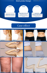 Nuovissima Macchina Coolwaves per Dimagrimento e Rassodamento della Pelle per Centri Estetici Professionali e Istituzioni - Product Image 3