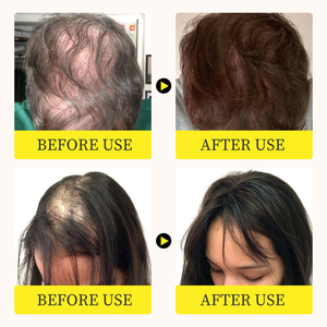 MOIKA Tratamento Capilar Personalizado 100% Natural Orgânico Eficaz Contra Queda de Cabelo Óleo de Crescimento com Biotina e Óleo Essencial de Alecrim - Product Image 2