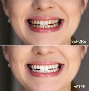 Kit Profesional de Blanqueamiento Dental con Luz Láser, Gel de Peróxido de Carbamida, Sistema de Blanqueamiento Seguro para el Hogar, para Manchas de Café y Humo - Product Image 6