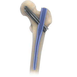 Clou intramédullaire manuel en acier inoxydable de qualité supérieure, instruments orthopédiques pour traumatismes, réutilisables, autoclavables, classe I CE - Product Image 3