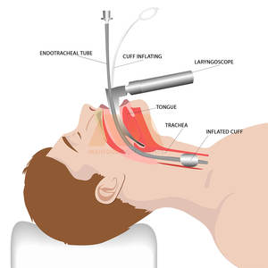 ชุดเครื่องมือส่องกล่องเสียงแบบทนทาน อุปกรณ์ทางการแพทย์สำหรับการผ่าตัดและการตรวจร่างกายผู้ป่วย ชุดส่องกล่องเสียงสำหรับหู คอ จมูก คุณภาพสูง - Product Image 6
