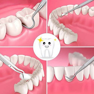 Professional Dental <b>Plaque</b> <b>Remover</b> 5-Piece Set Manual German Stainless Steel CE Certified Ergonomic Grip <b>Tooth</b> Filling Repair - Product Image 3