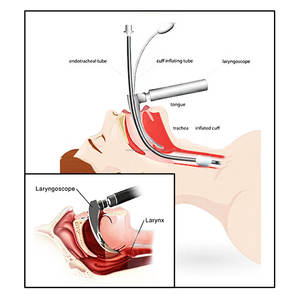 Kit chirurgical de laryngoscope Macintosh, 5 lames, manche manuel, fibre optique, acier inoxydable, réutilisable, certifié CE, usage hospitalier - Product Image 2