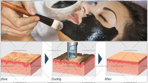 Machine de traitement de la peau au laser Pico et au <span class=keywords><strong>peeling</strong></span> au carbone, élimination des tatouages, traitement des pigments (laser NdYag) 1064nm/755nm, stationnaire - Product Image 6