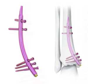 Clavo Intramedular Tibial Distal (DTN) de Alta Calidad, Implantes e Instrumentos Quirúrgicos Ortopédicos - Product Image 4