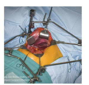 Bonne offre Thompson Retractor System Instruments orthopédiques chirurgicaux - Product Image 4