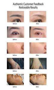 Mesin Penghilang Tato Picosecond Tanpa Bekas untuk <span class=keywords><strong>Nevus</strong></span>, Bintik Vaskular & Lesi Berpigmen - Product Image 4
