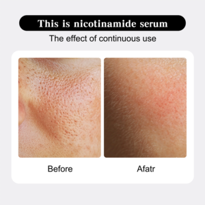 תווית פרטית 10% סרום ניאצינמיד 1 עוז-איזון ב 3 קרם עם ויטמין <span class=keywords><strong>b5</strong></span> ו-b3 להלבנת ולהתייבשות - Product Image 5