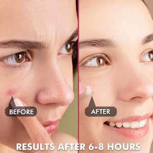 スキンケア マイクロニードル ニキビパッチ 急速成分浸透 アクネパッチ - Product Image 5