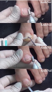 Fabriqué en corée Dr.Kralle ongle incarné ongle incurvé kit de soin des outils correctifs activateur nettoyant curette colle orthèse pincettes - Product Image 6