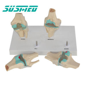 Science médicale anatomie humaine modèle de maladie articulaire modèle de combinaison d'articulation du genou pathologique en 4 étapes - Product Image 3