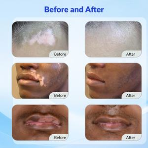 Dispositivo de Terapia de Luz Excimer de 308nm Avanzado y Dirigido ZJZK para el Tratamiento Profesional del Vitiligo, Máquina de Fototerapia UVB - Product Image 4