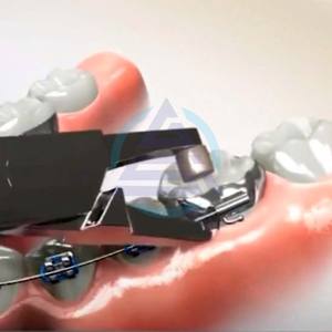 Alicates para Remover Adhesivos, Fórceps para Remover Dientes Posteriores con Anillo, Herramientas Dentales de Ortodoncia, Instrumentos de Odontología - Product Image 2