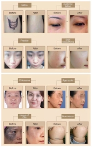 Machine de traitement de la peau au laser Pico et au <span class=keywords><strong>peeling</strong></span> au carbone, élimination des tatouages, traitement des pigments (laser NdYag) 1064nm/755nm, stationnaire - Product Image 5