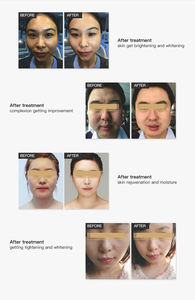 กระชับผิวอย่างมืออาชีพไม่เจ็บปวดความดันสูงไม่มีเข็มฟื้นฟูผิว - Product Image 6