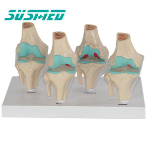 Science médicale anatomie humaine modèle de maladie articulaire modèle de combinaison d'articulation du genou pathologique en 4 étapes - Product Image 1