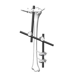 Nuevo Sistema de Fijación Externa de Fémur Médico Profesional de Primera Calidad, Venta Caliente 2025, Juego de Instrumentos Personalizados de 8 mm - Product Image 6