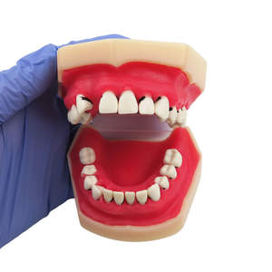Modelo Educativo de Enseñanza Dental, Modelo de Enfermedad Periodontal - Product Image 1