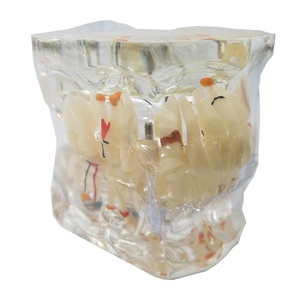 Modèle de pathologie dentaire avec demi-implant, modèle anatomique des dents pour l'enseignement dentaire, l'étude et la communication patient-dentiste - Product Image 6
