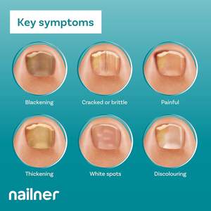 Nailner - Pluma de Tratamiento Antifúngico para Uñas de 4 ml, Solución Extra Fuerte para Infecciones Fúngicas de las Uñas de los Pies, Suministros para Uñas - Product Image 5