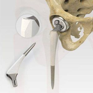 Corail Femorale Steel Titanium Implantaat Voor Totale Heupprothese Ce Gecertificeerd Kunstmatig Heupgewricht Systeem Stalen Prothese