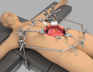 Retractor Thompson de suministro hospitalario | Retractores quirúrgicos a granel para clínicas y o retractor ortopédico Thompson | Autorretención - Product Image 6