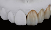Blocs de zircone de disque à bas prix 98mm 95mm 14mm 16mm 20mm pour laboratoire dentaire Zirdent 3D-Pro-ML consommable dentaire multicouche en céramique