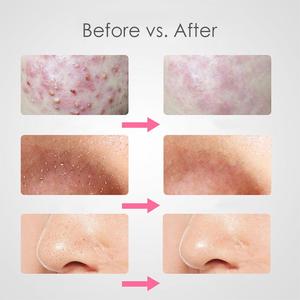 เครื่องมือกำจัดสิวหัวดำสแตนเลส,เครื่องมือสปากำจัดสิวหัวดำอุปกรณ์ดูแลความงามทำโลโก้ได้ตามต้องการ - Product Image 6