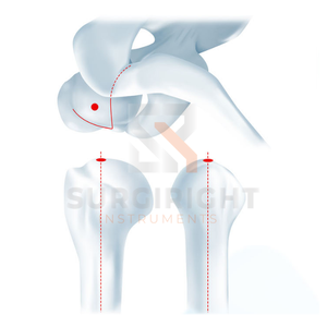 ชุดเครื่องมือผ่าตัดเล็บแบบมีหลายล็อคกระดูกต้นแขนทำจากไทเทเนียมอัลลอย - Product Image 2
