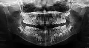 İtalya MyRay Hyperion X9 Dijital 3'ü 1 Arada Diş CBCT Cihazı, Ceph Özellikli Diş Panoramik Cihazı - Product Image 5