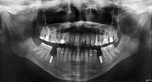 İtalya MyRay Hyperion X9 Dijital 3'ü 1 Arada Diş CBCT Cihazı, Ceph Özellikli Diş Panoramik Cihazı - Product Image 4